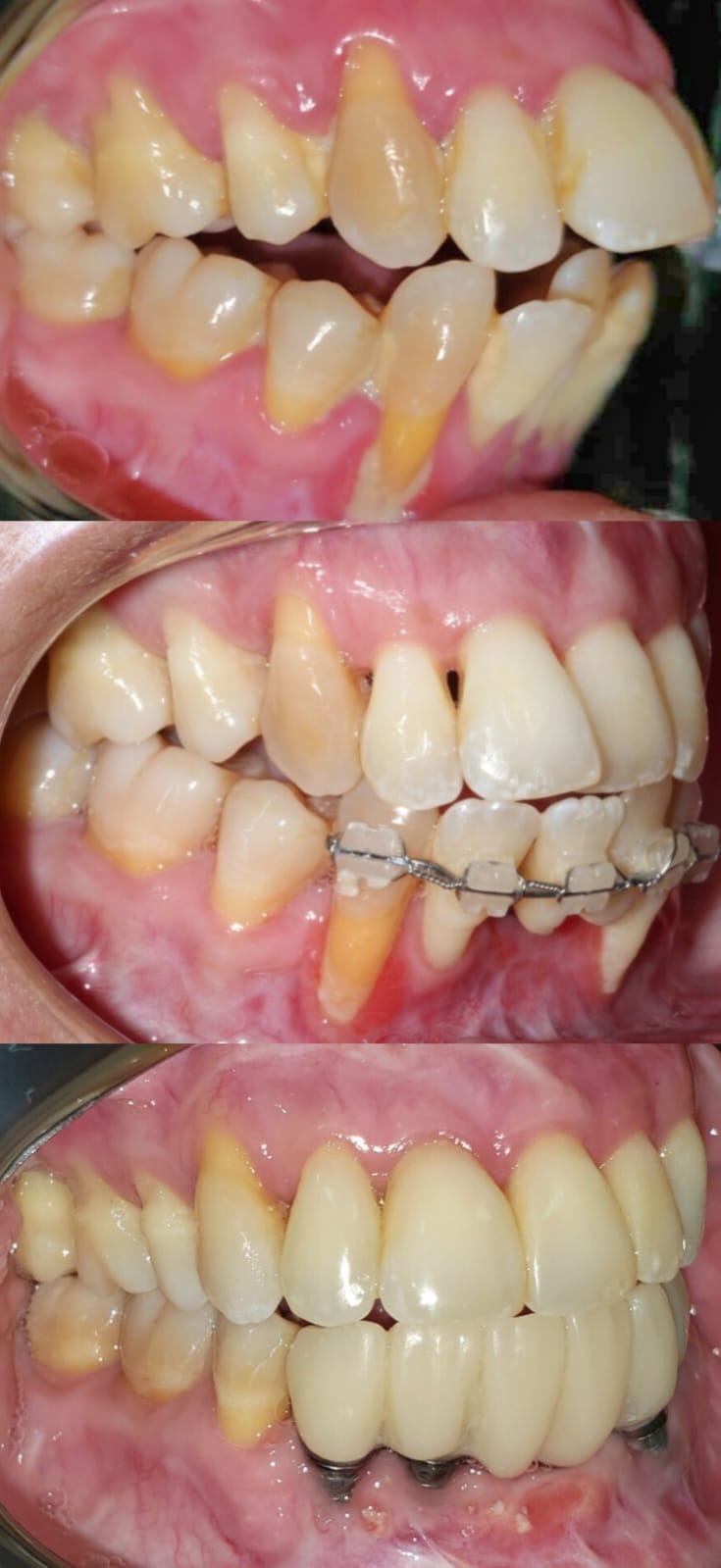 Caso de doença periodontal avançada tratado pela Dra. Glenda Vacchiano em Ipanema