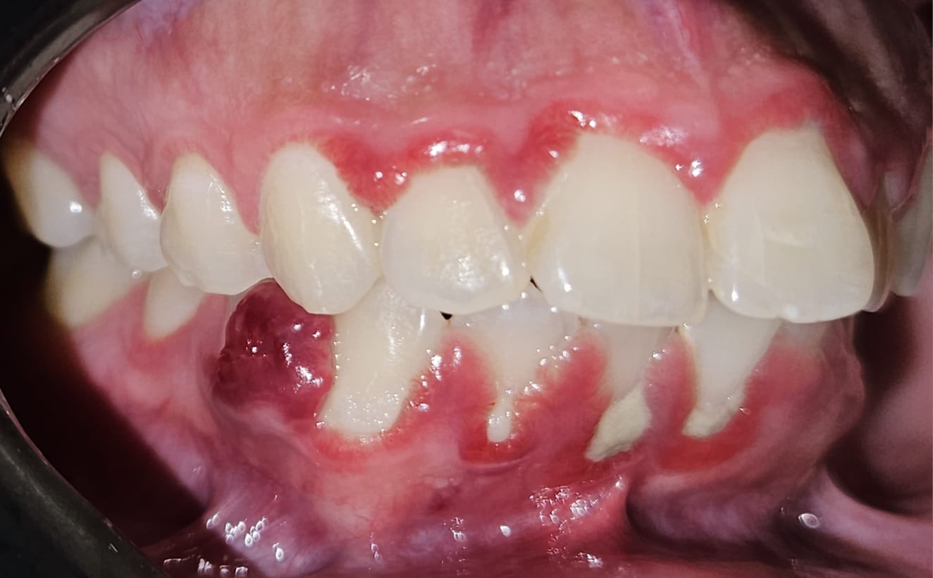 Caso de gengivite e inflamação gengival, Dra. Glenda Vacchiano, Ipanema