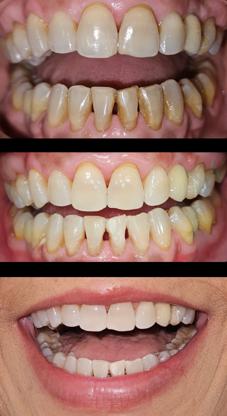 Resultado de profilaxia e limpeza profissional, Dra. Glenda Vacchiano, Ipanema