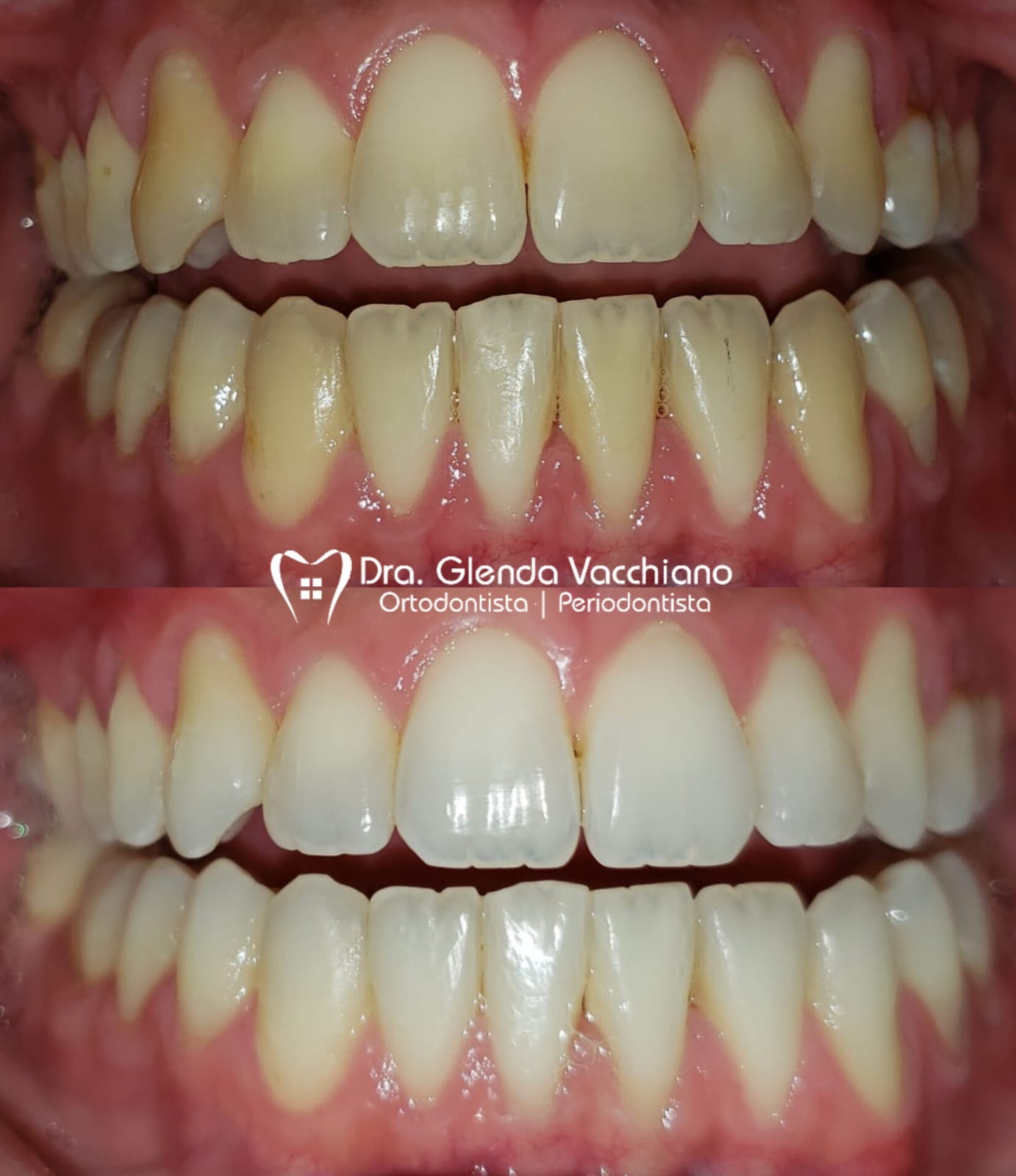 Resultado de manutenção periodontal preventiva, Dra. Glenda Vacchiano, Ipanema
